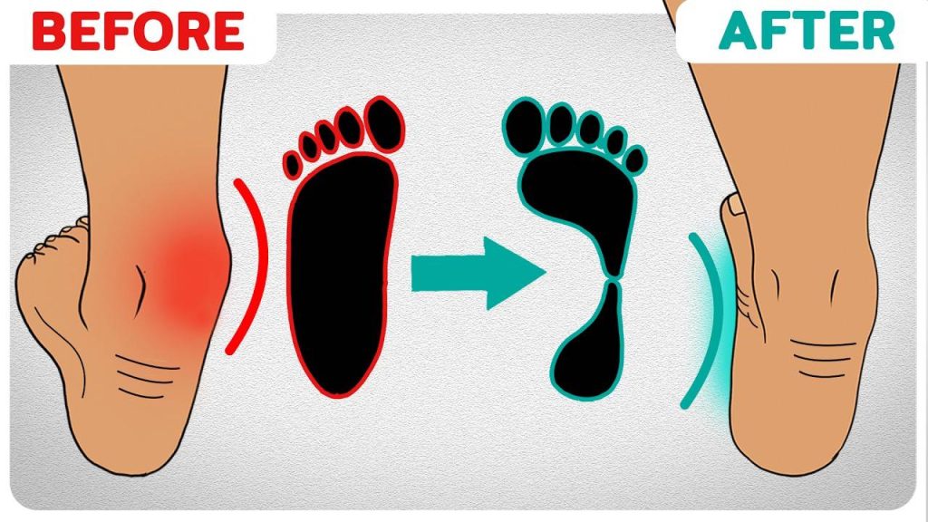 pronation-foot-before-after