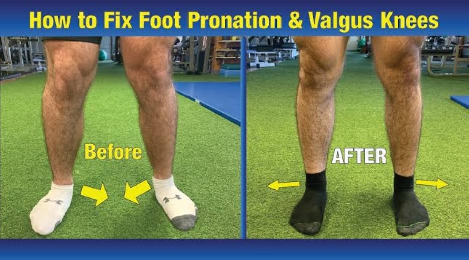 pronation-foot-before-after-2